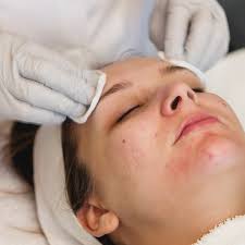 treating acne